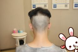 点击看大图 -大麦微针植发丨全国连锁