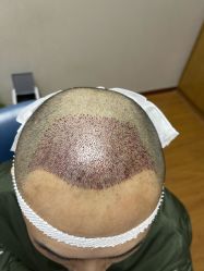 体验后-大麦微针植发全国连锁