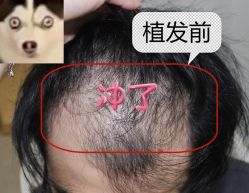 -大麦微针植发全国连锁