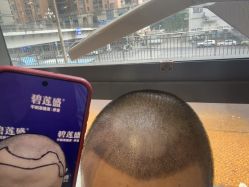 -碧莲盛·不剃发植发