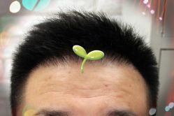 -大麦微针植发全国连锁