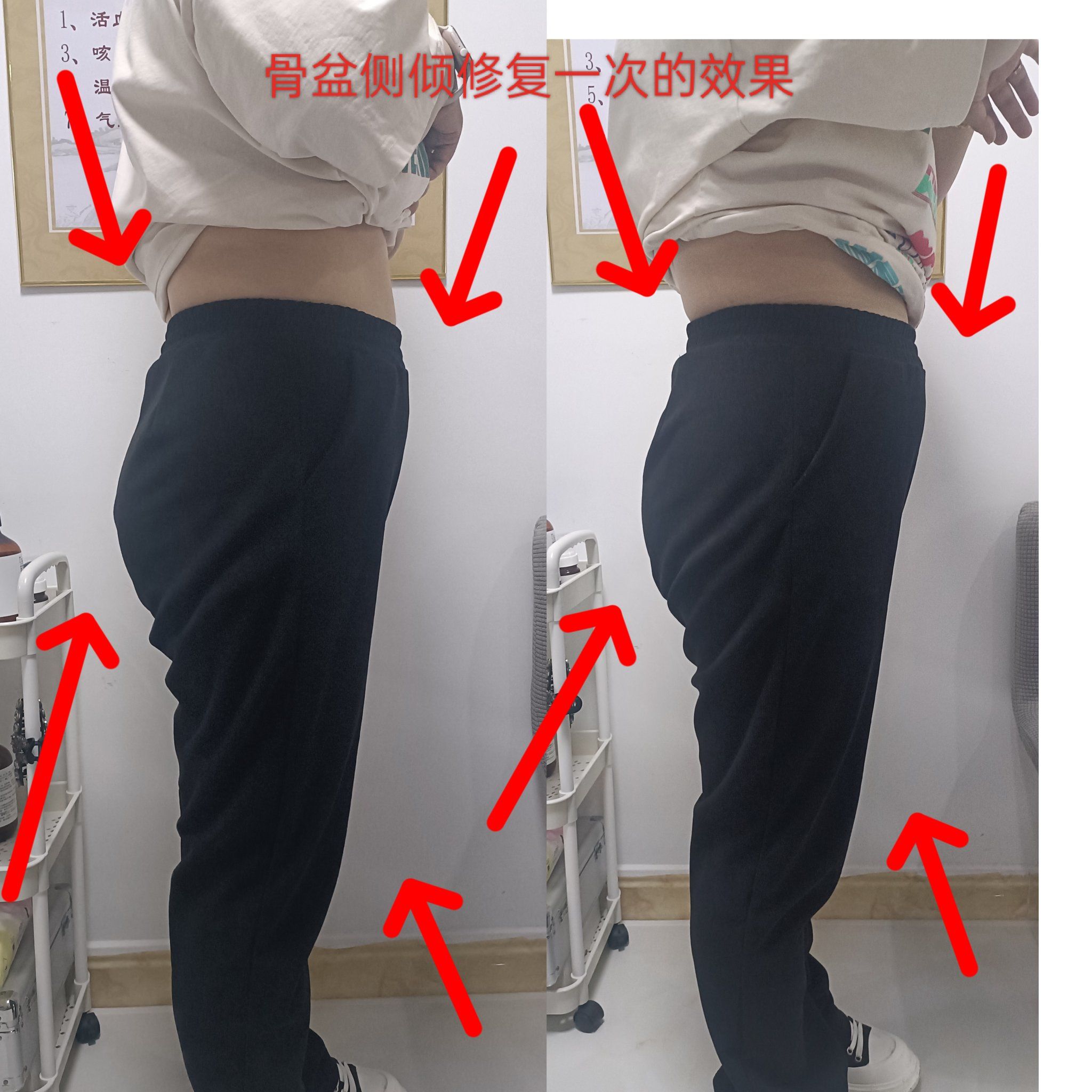 骨盆侧倾