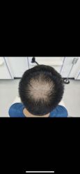 点击看大图 -大麦微针植发全国连锁