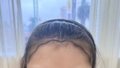 -碧莲盛·不剃发植发