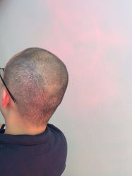 -大麦微针植发全国连锁