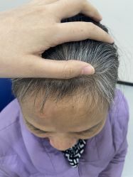 -大麦微针植发全国连锁