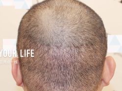 -大麦微针植发全国连锁