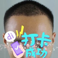 -大麦微针植发全国连锁