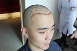 点击看大图 -大麦微针植发丨全国连锁