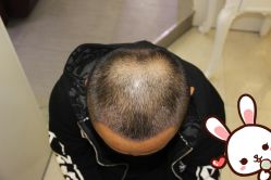 点击看大图 -大麦微针植发丨全国连锁