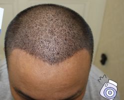 -大麦微针植发丨全国连锁