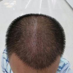 点击看大图 -大麦微针植发全国连锁