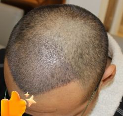 -大麦微针植发丨全国连锁