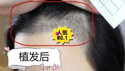 -大麦微针植发全国连锁