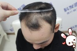 -大麦微针植发丨全国连锁