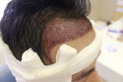 -大麦微针植发丨全国连锁