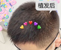 -大麦微针植发全国连锁