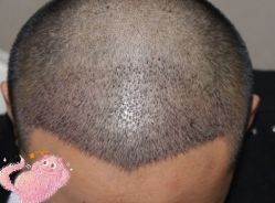 -大麦微针植发丨全国连锁