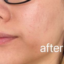 体验后-东莞缔美美容医院