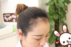 点击看大图 -大麦微针植发丨全国连锁