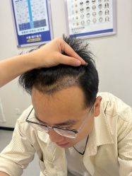 -大麦微针植发全国连锁