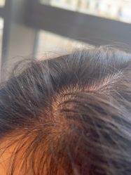 -碧莲盛·不剃发植发