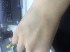 输液留下的针孔-丰茂烤串(金泉美食宫店)