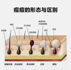 -蕾特恩专业祛痘