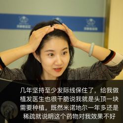 -碧莲盛·不剃发植发