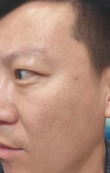-北京美痣堂古方祛痣斑疣瘊