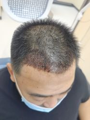 -大麦微针植发全国连锁