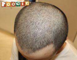 -大麦微针植发丨全国连锁