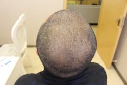 -大麦微针植发丨全国连锁