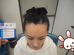 -大麦微针植发丨全国连锁