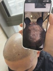 -碧莲盛·不剃发植发