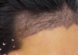 -大麦微针植发丨全国连锁