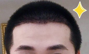 -大麦微针植发丨全国连锁