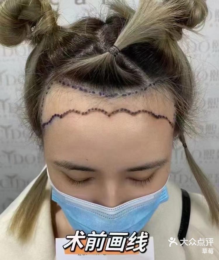 植发脸胸几天(植发完脸部肿了怎么办)