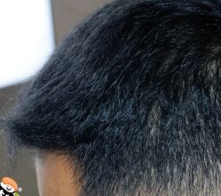 -大麦微针植发丨全国连锁