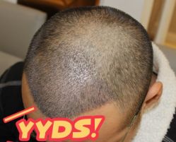 -大麦微针植发丨全国连锁