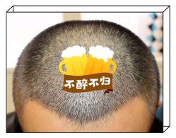 -大麦微针植发全国连锁