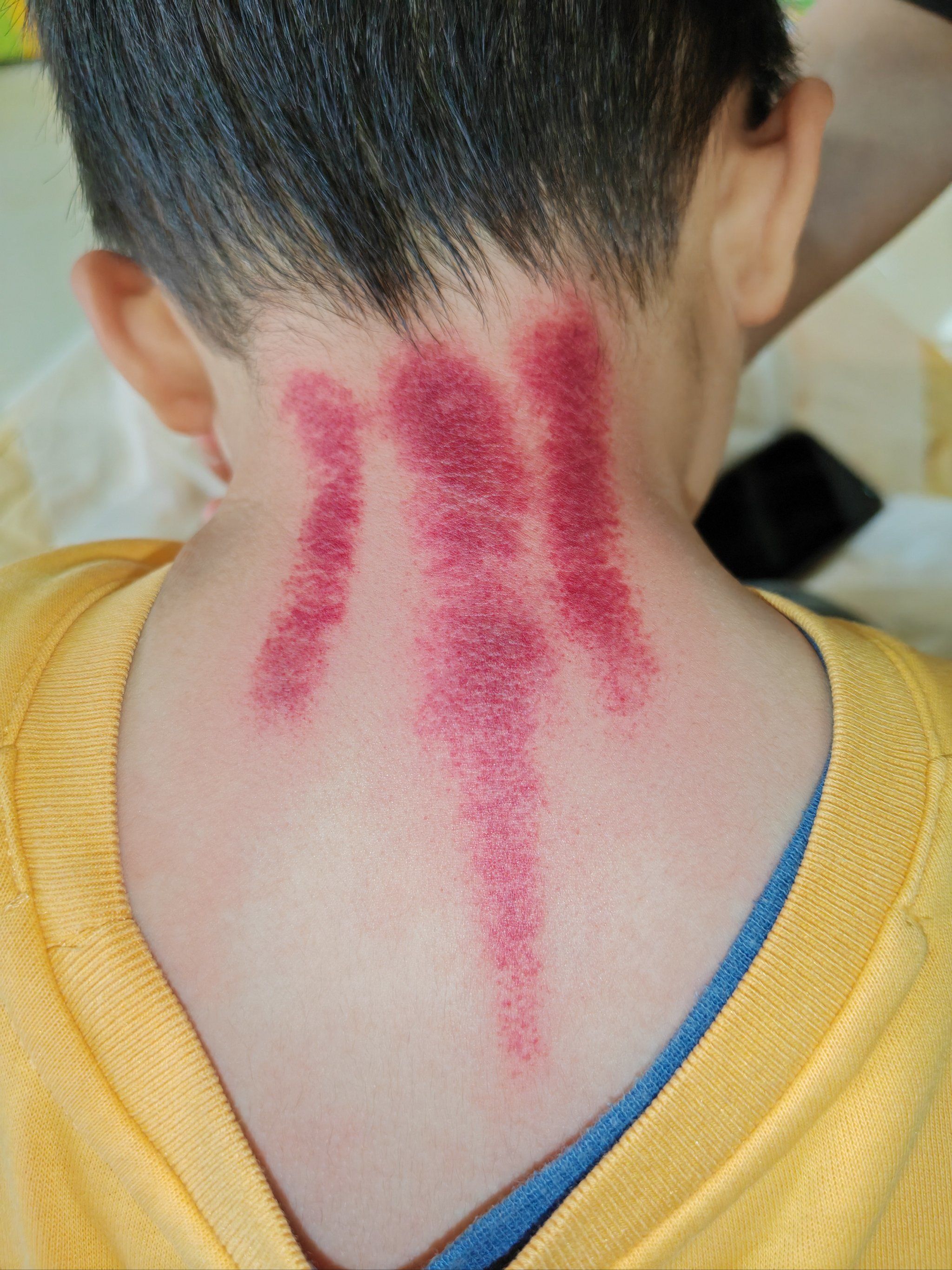 n*推拿配合项后刮痧#小儿推拿 「小儿推拿