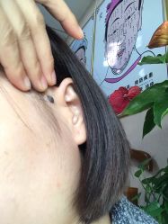 -北京美痣堂古方祛痣斑疣瘊