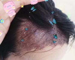 -大麦微针植发全国连锁