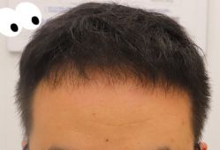 -大麦微针植发全国连锁