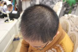 点击看大图 -大麦微针植发丨全国连锁