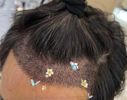 -大麦微针植发全国连锁