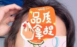 -大麦微针植发全国连锁