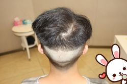 点击看大图 -大麦微针植发丨全国连锁