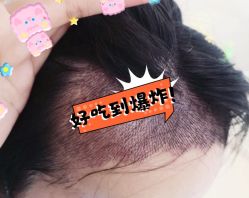 -大麦微针植发全国连锁